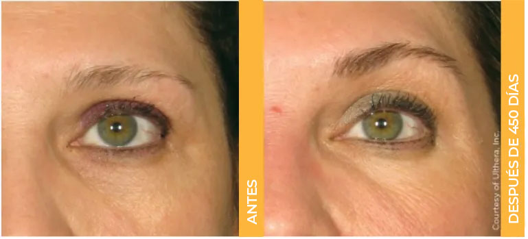 Acercamiento de antes y después de las cejas de una paciente real de Ultherapy<sup>&reg;</sup>, mostrando resultados de lifting después de 450 días.