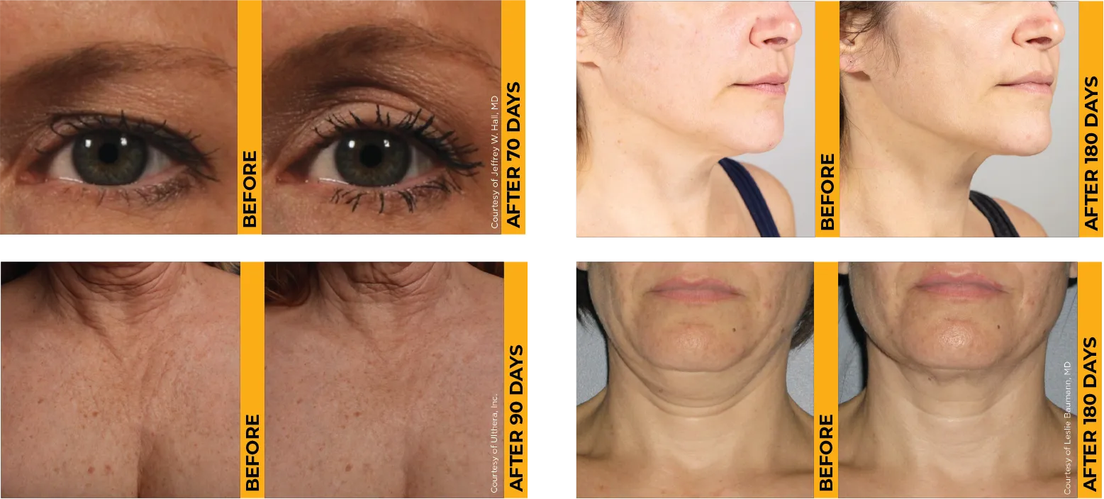 Cuatro fotos de antes y después que muestran resultados probados de lifting de la piel en cejas, mentón, escote y cuello.