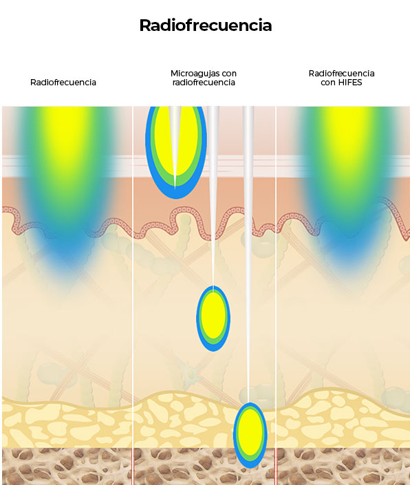 Diagrama que compara los tratamientos de radiofrecuencia con la penetración más profunda de Ultherapy<sup>&reg;</sup> en las capas de la piel.