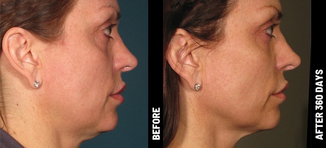 Imágenes de antes y después, lado a lado, que muestran resultados de lifting y tensado de la piel después de Ultherapy. Diana, 62