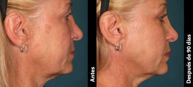Imágenes de antes y después, lado a lado, que muestran resultados de lifting y tensado de la piel después de Ultherapy. 