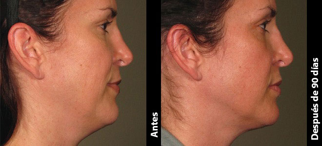 Imágenes de antes y después, lado a lado, que muestran resultados de lifting y tensado de la piel después de Ultherapy. 