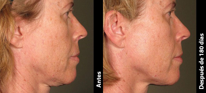 Imágenes de antes y después, lado a lado, que muestran resultados de lifting y tensado de la piel después de Ultherapy. 
