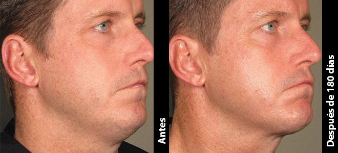 Imágenes de antes y después, lado a lado, que muestran resultados de lifting y tensado de la piel después de Ultherapy. 