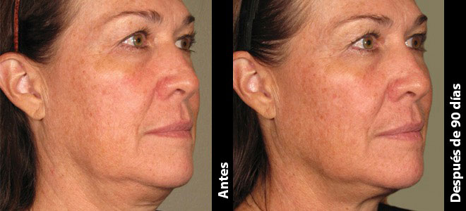 Imágenes de antes y después, lado a lado, que muestran resultados de lifting y tensado de la piel después de Ultherapy. 