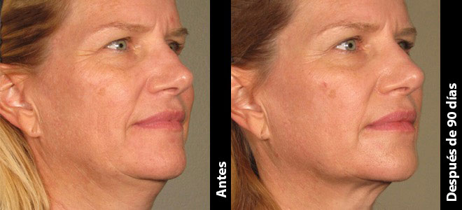 Imágenes de antes y después, lado a lado, que muestran resultados de lifting y tensado de la piel después de Ultherapy. 