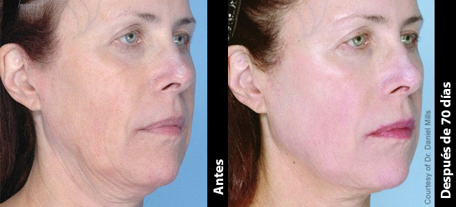 Imágenes de antes y después, lado a lado, que muestran resultados de lifting y tensado de la piel después de Ultherapy. 