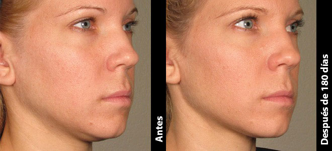 Imágenes de antes y después, lado a lado, que muestran resultados de lifting y tensado de la piel después de Ultherapy. 