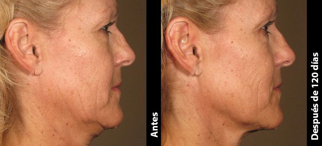 Imágenes de antes y después, lado a lado, que muestran resultados de lifting y tensado de la piel después de Ultherapy. 