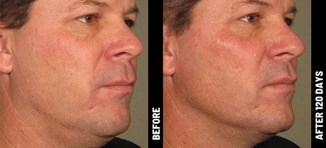 Imágenes de antes y después, lado a lado, que muestran resultados de lifting y tensado de la piel después de Ultherapy. 